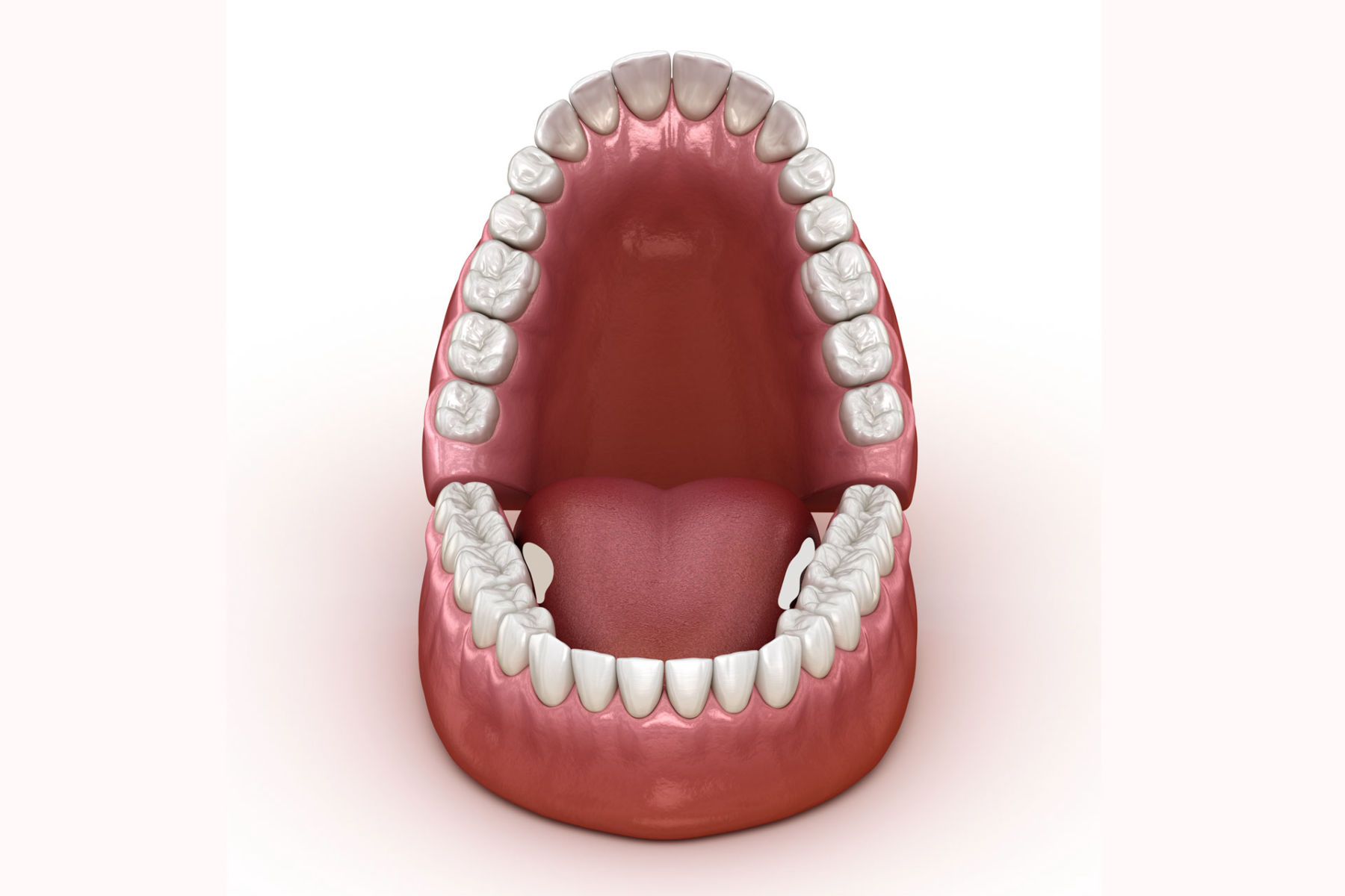 What In The World Are Tori Our Calgary Dentist Explains Advance What In The World Are Tori Our Calgary Dentist Explains Advance