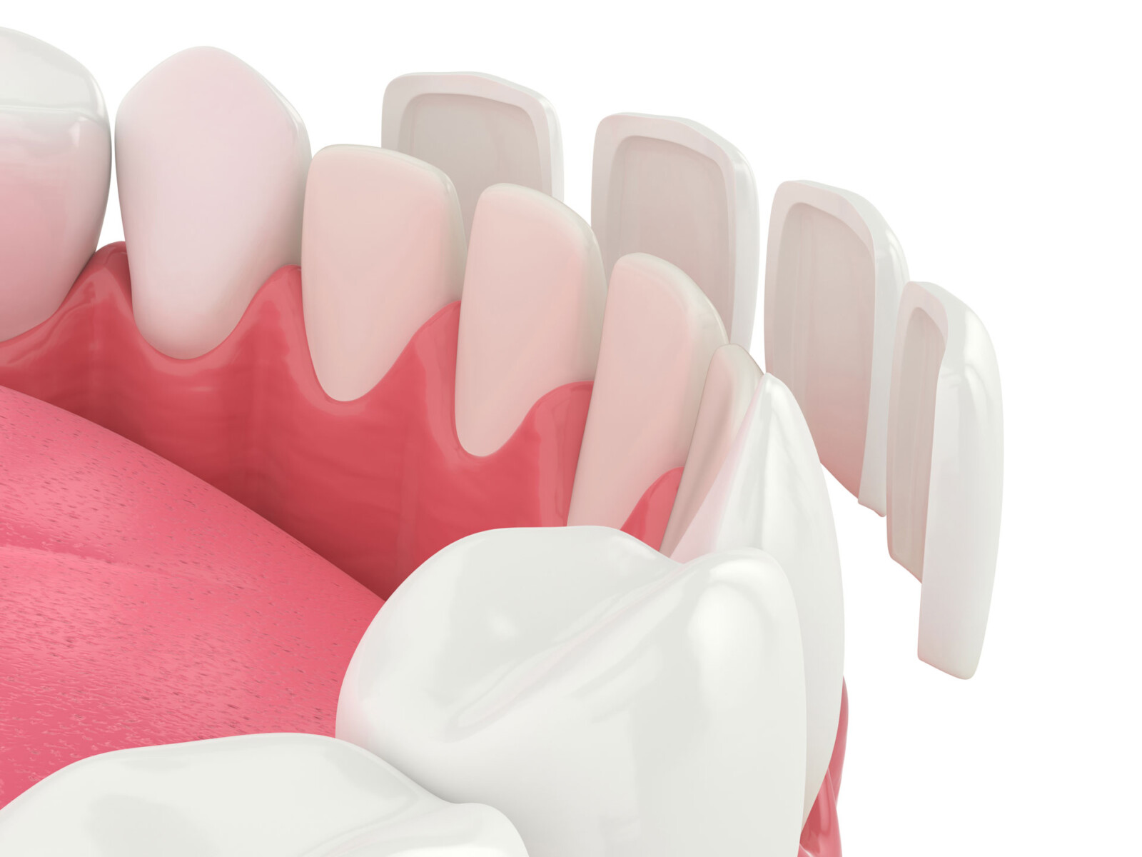 dental veneers