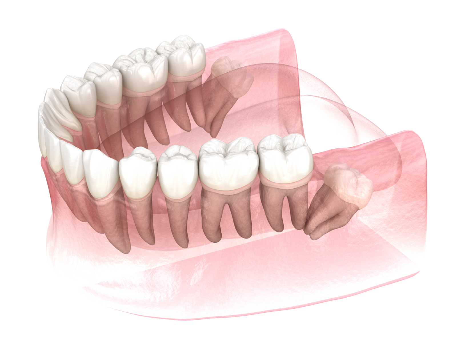 wisdom tooth