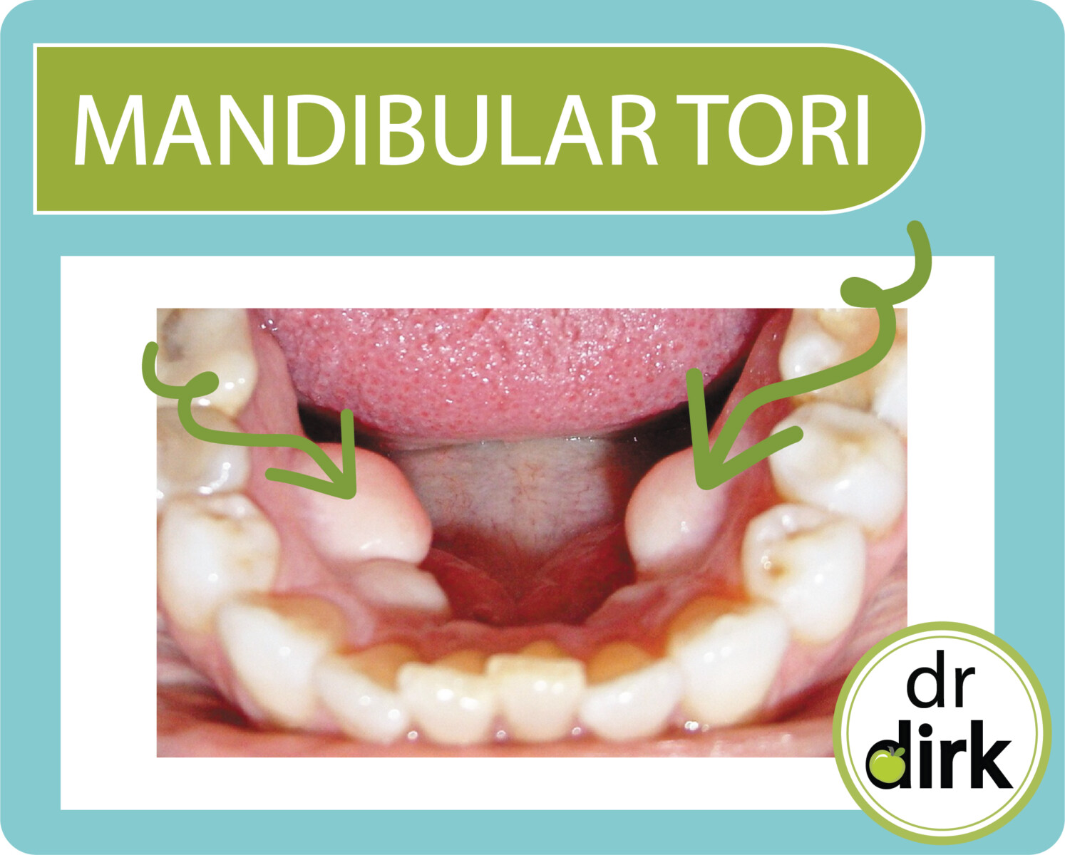 What in the World Are Tori? Our Calgary Dentist Explains. Advance